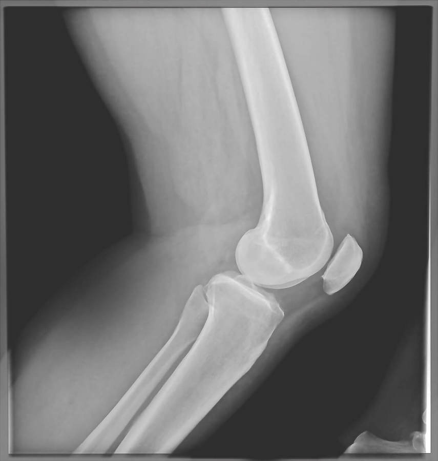 acuity_competior-leg_xray