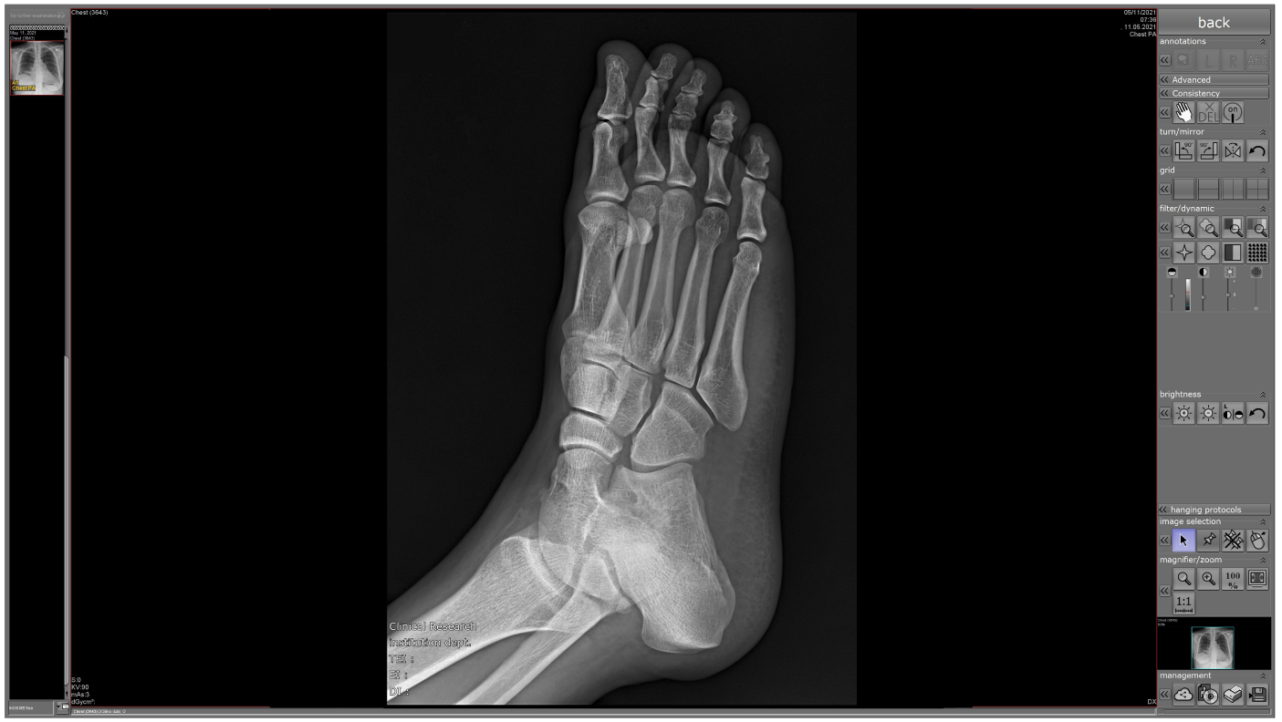 AccuVue Foot X-Ray